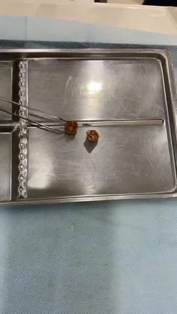 Răng 8 gây viêm, giắt thức ăn, sâu mặt nhai, chân răng to chỉ cần 2 phút để đánh bật