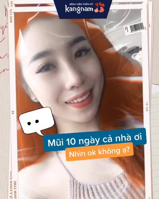 Mới 10 ngày MŨI DỌC DỪA - TỰ NHIÊN như thế này đây! Chỉ từ 17.5 Triệu thôi ạ, xứng đáng đầu tư NÂNG MŨI đúng không chị em?