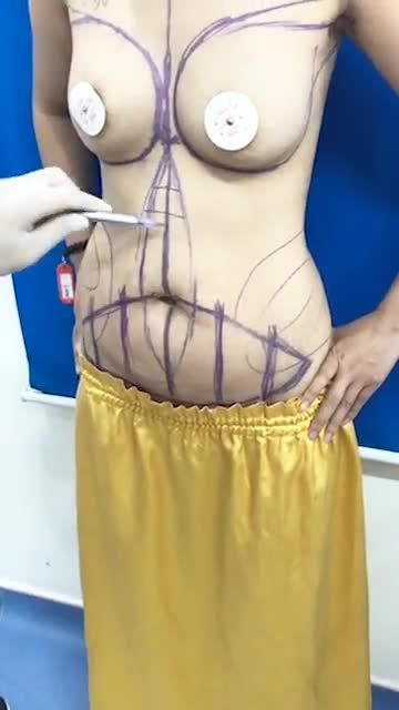 Bác sĩ Kangnam đo vẽ, phân tích cho khách hàng sử dụng Combo dịch vụ: .Thay túi ngực .Giảm mỡ bụng .tạo hình Body S line