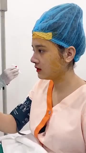 Nâng mũi cấu trúc sụn tai dáng Sline cao vừa cho khách hàng sóng mũi thấp, trụ mũi ngắn của bác si Sơn Tùng Az Nose