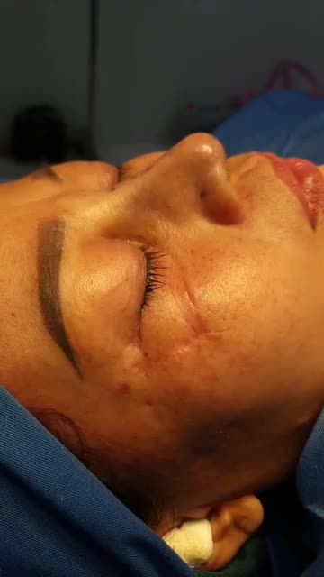 Nâng mũi sụn tai 2 lớp