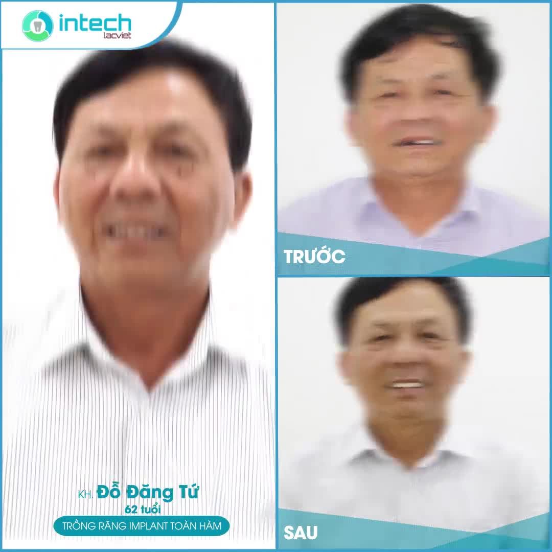 "TÁI SINH" TOÀN BỘ RĂNG HÀM TRÊN, ĂN NHAI THOẢI MÁI NHỜ TRỒNG RĂNG IMPLANT ALL - ON - 4