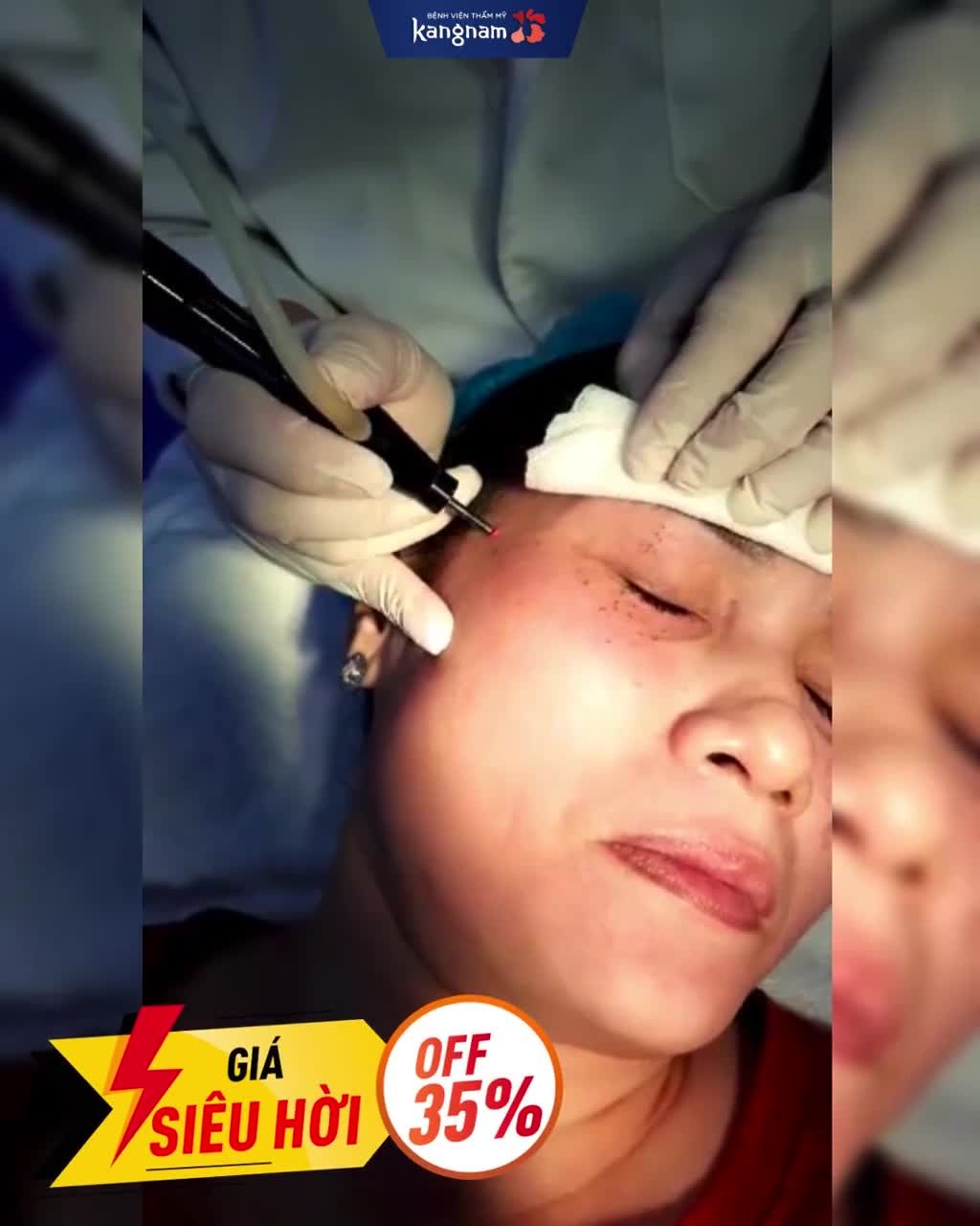 Trị mụn thịt giá hời - OFF tới 35%