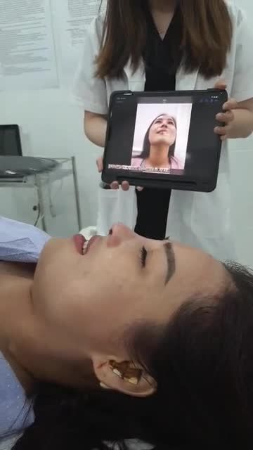CẤU TRÚC SỬA LẠI SỤN NANOFORM ĐẸP NGẤT NGÂY