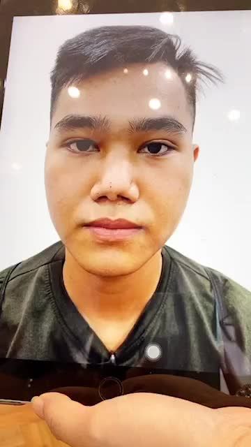 CHIA SẺ CỦA CHÀNG TRAI TRẢI QUA 11 LẦN PHẪU THUẬT NÂNG MŨI