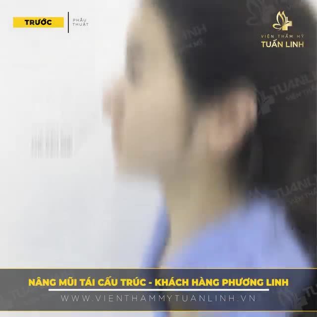 Khách hàng nhà Tuấn Linh tự tin vô cùng với chiếc mũi xinh hoàn hảo tôn lên gương mặt thanh thoát của mình.