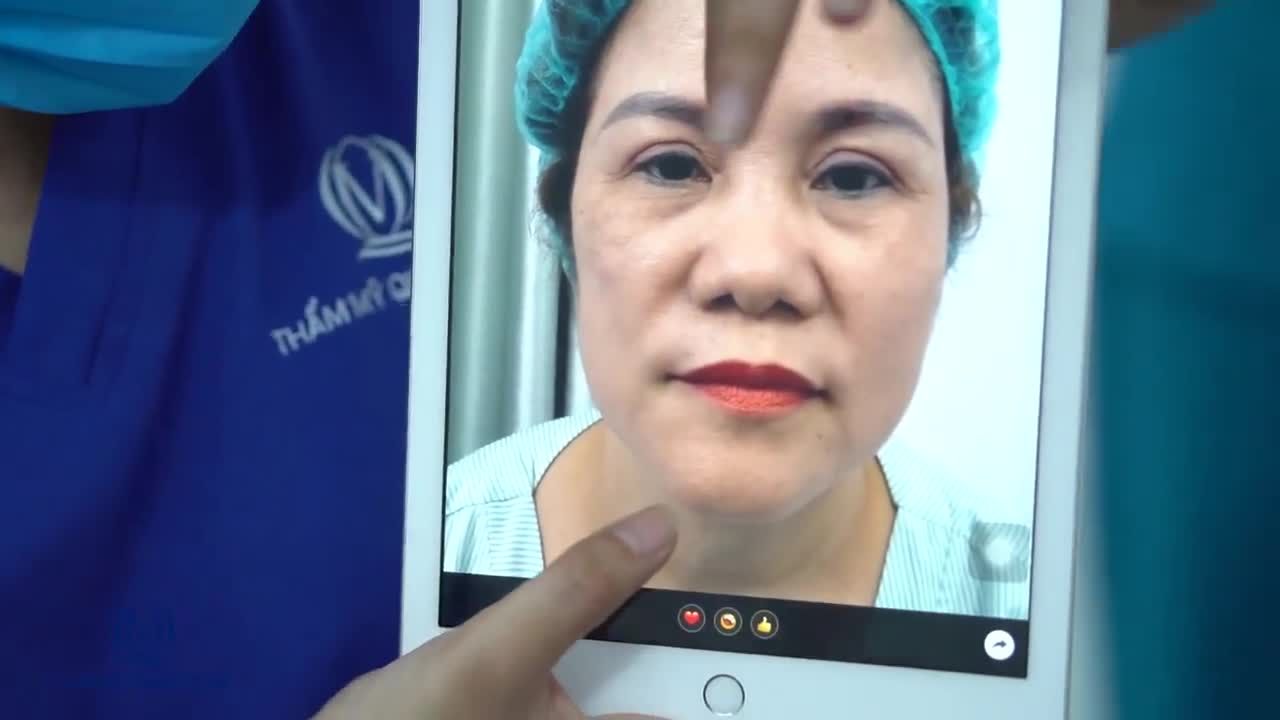 Mũi thấp sống - Mũi thô to - Đầu mũi hếch