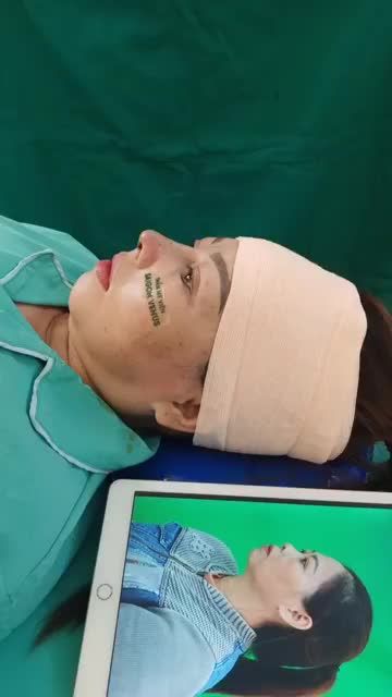 Nâng mũi cấu trúc Fascial chỉ mới làm thôi mà đẹp xuất sắc quá cả nhà ơi