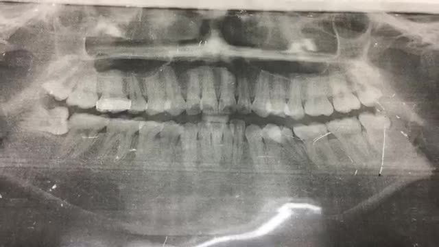 Nhổ răng khôn số 28, 38 mọc kẹt, lợi trùm cho chị Hằng