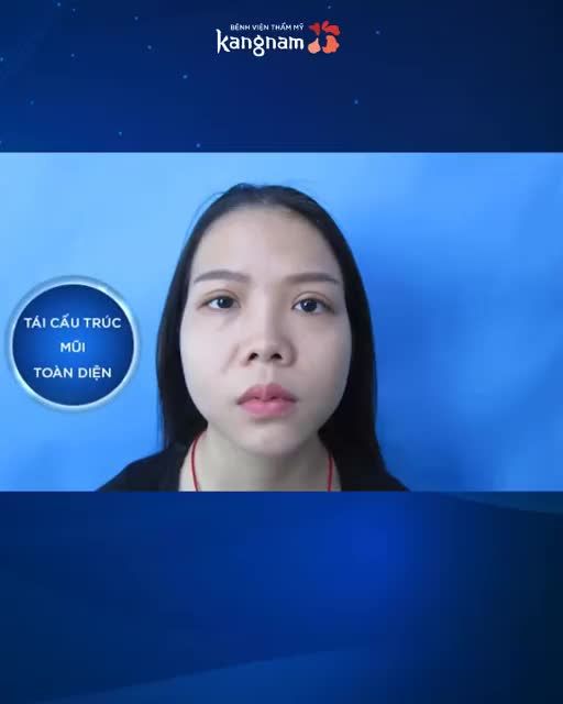 06 LÝ DO NÂNG MŨI CẤU TRÚC 4D "lý tưởng" hơn Nâng mũi bọc sụn