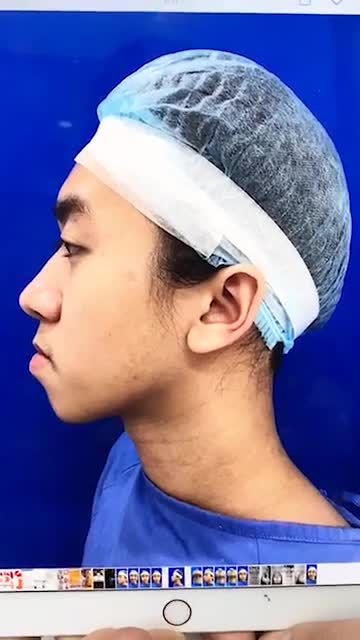 NAM SINH 2K "LỘT XÁC" THÀNH "NAM THẦN" SAU PHẪU THUẬT CHỈNH HÀM