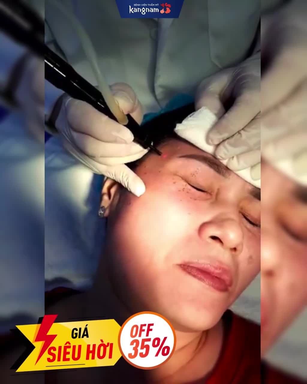 Chỉ từ 650K  Sạch tận gốc mụn thịt!