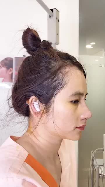 KHẮC PHỤC MŨI LỆCH - DA MỎNG - SÓNG GỒ