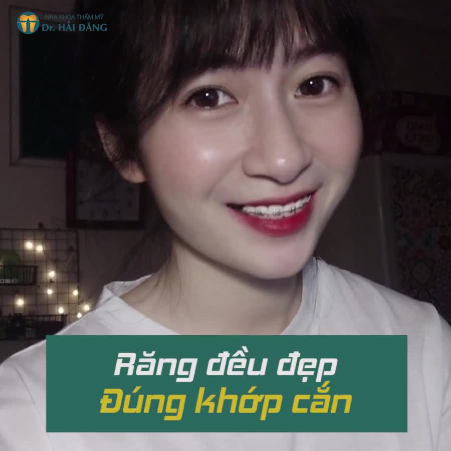 NIỀNG RĂNG MẮC CÀI - CHINH PHỤC NỤ CƯỜI TỰ TIN