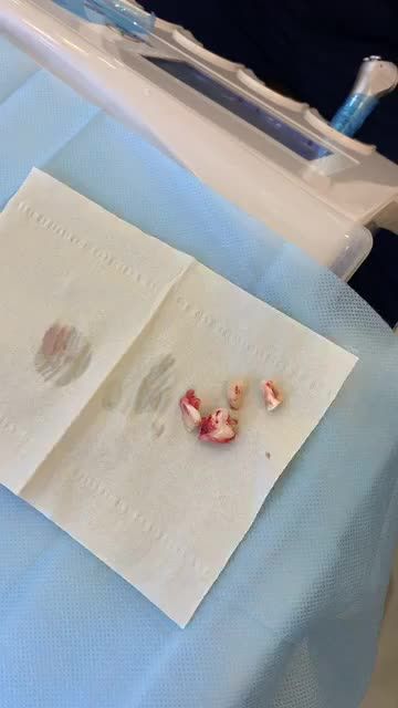 Răng số 8 đã nhổ ở cơ sở khác bị chảy máu quá nhiều, không thể nhổ được gây đau nhức. Bác sĩ tại Delia giải cứu như thế nào? Xem ngay livestream