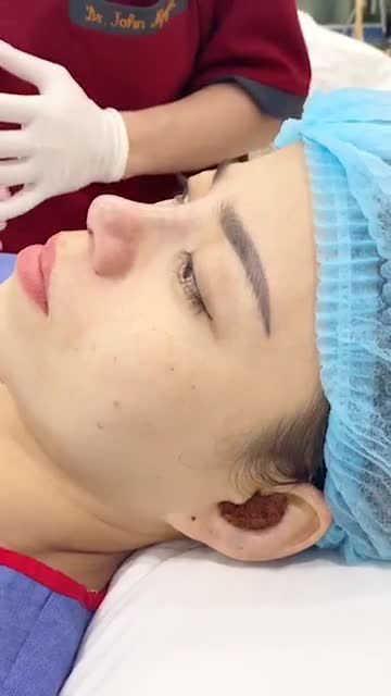 Kết quả nâng mũi CT4D sau 1giờ phẫu thuật - quy trình nẹp mũi đạt chuẩn của Kangnam