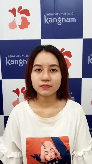 SIÊU SALE mũi đẹp tháng 6 này!! Nâng mũi cấu trúc 4D và kết quả bất ngờ!