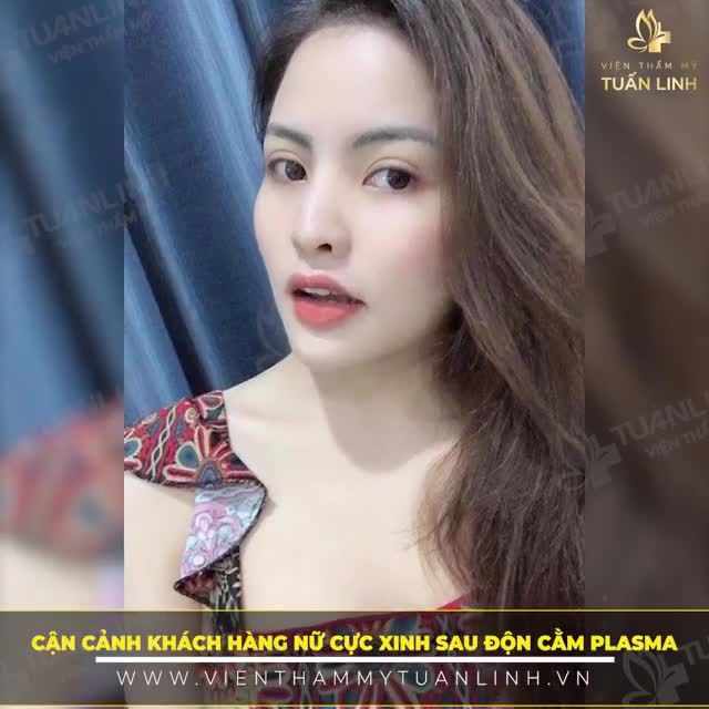 Độn cằm Vline -SIÊU TỰ NHIÊN