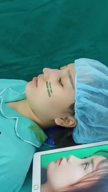 KHÁCH HÀNG TRÚNG GIẢI "CHINH PHỤC HOÀN MỸ" - TẬP 4 NÂNG MŨI CẤU TRÚC FASCIAL