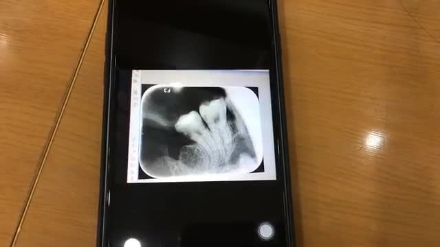 Nhổ răng khôn cho khách hàng tại Nha Khoa Thuỳ Anh