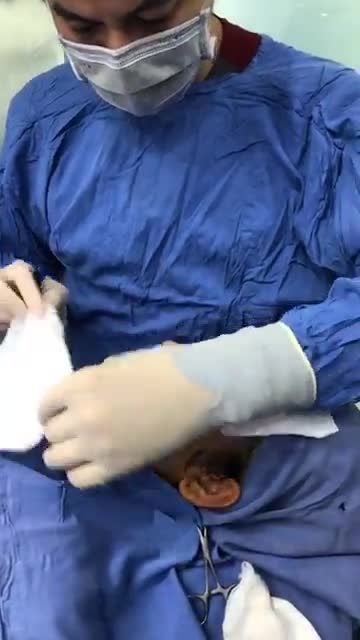 Chỉnh hình mũi gồ- tạo dáng mũi mềm mại nữ tính cho khách hàng cùng Bác sĩ Kangnam