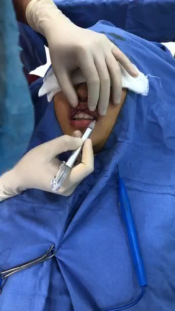 Công đoạn đo vẽ tạo hình môi tim - nụ cười duyên dáng cùng Kangnam