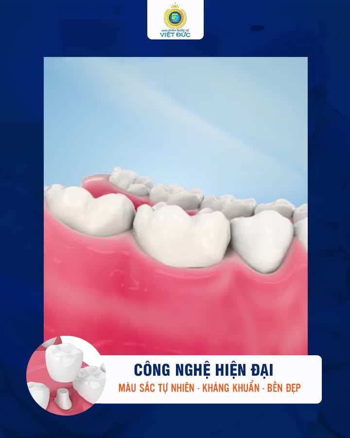 BỌC RĂNG SỨ NANO CERAMIC – RĂNG ĐẸP TRỌN ĐỜI GIÁ SIÊU HỜI ‼ GIẢM 20%