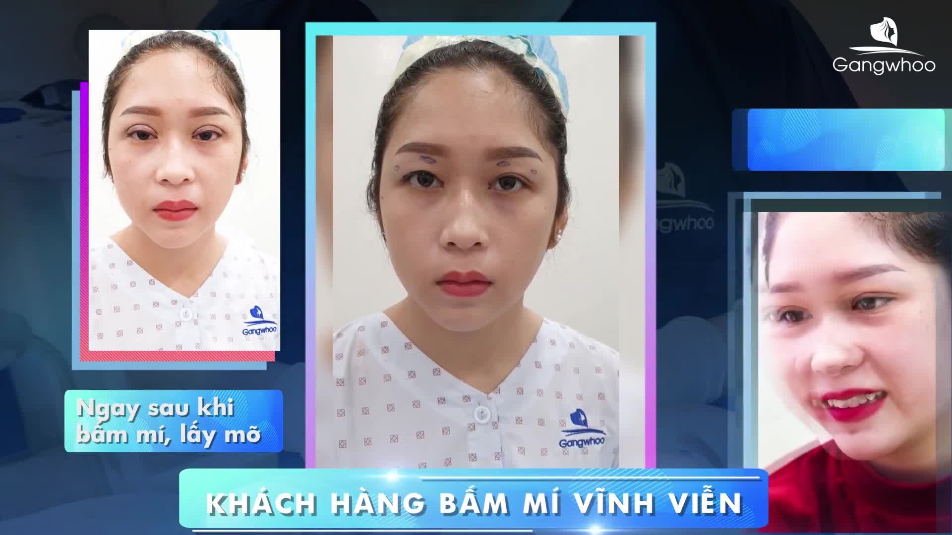 MẮT 2 MÍ - HẾT MẮT BUỒN MÀ KHÔNG CẦN PHẪU THUẬT
