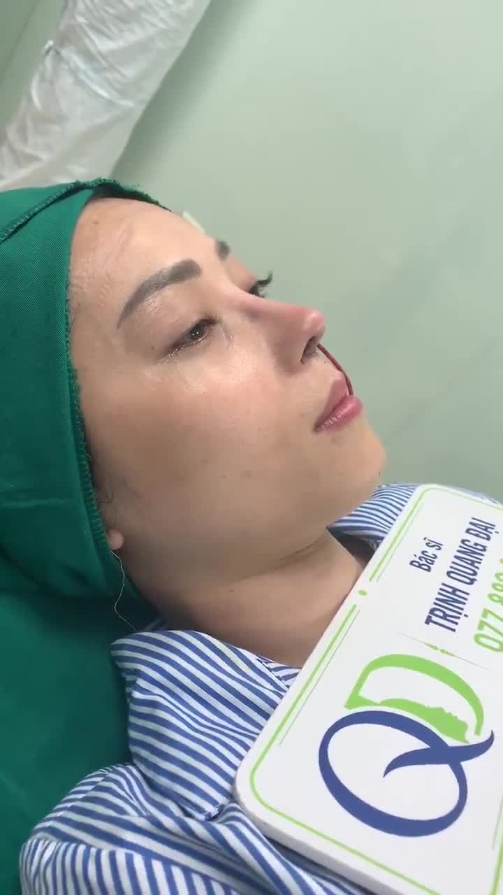 MŨI SỬA LẠI CẤU TRÚC SURGIFORM SIÊU XỊN