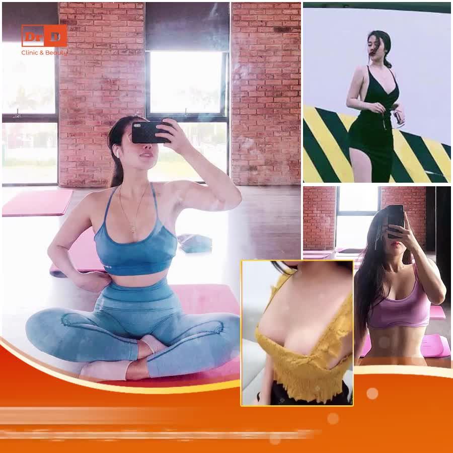Nâng ngực độn túi là cách nhanh nhất để có vòng 1 căng tròn, săn chắc.