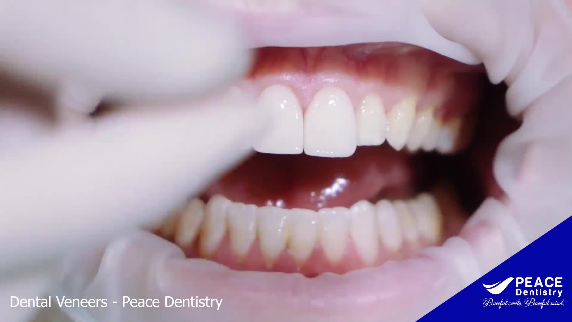Quy trình chuẩn cho mặt dán sứ Veneer - Peace Dentistry