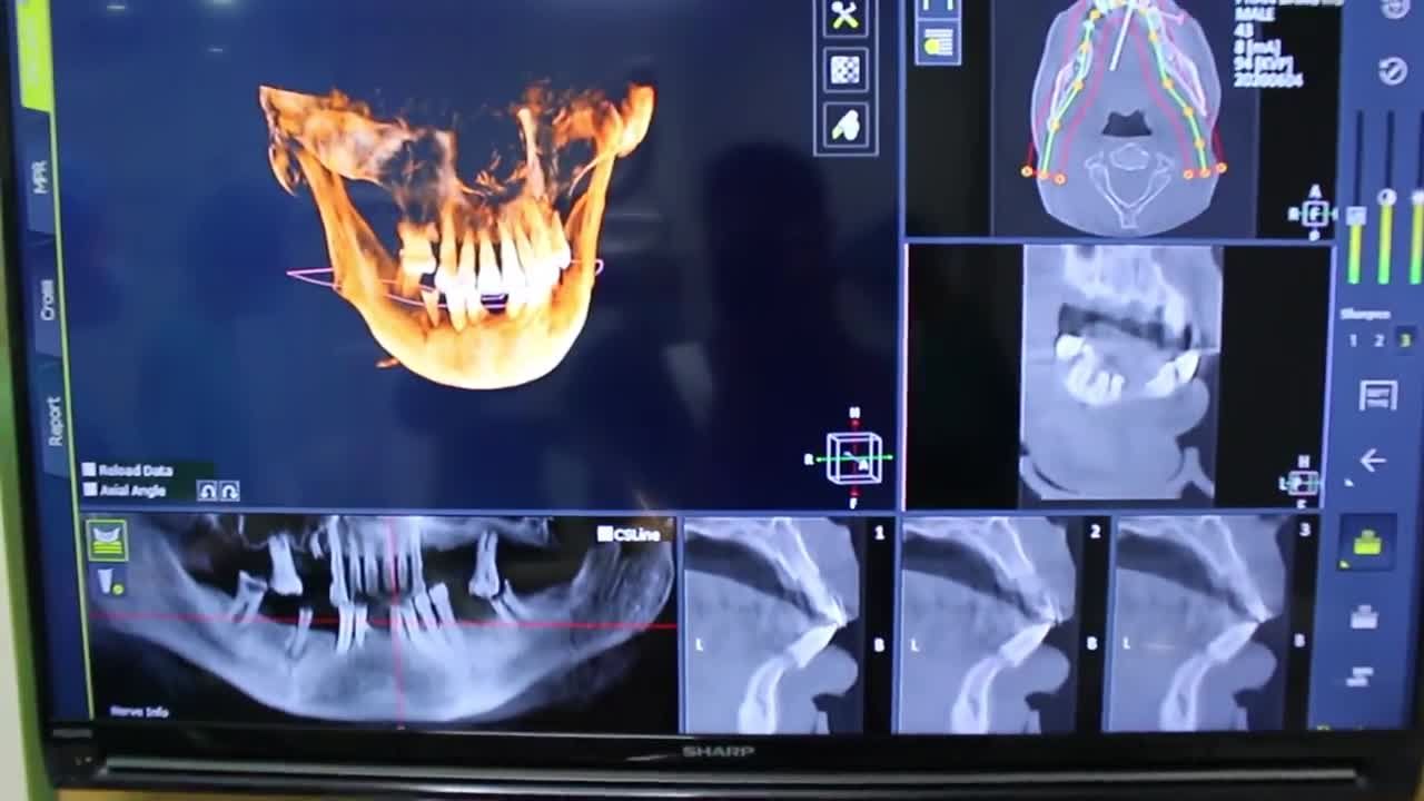 10 SỰ THẬT THÚ VỊ VỀ TRỒNG RĂNG IMPLANT