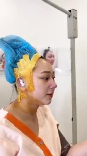 Khách hàng sóng mũi thấp, mô đầu mũi to, hai cánh mũi to bè, nền xương không đều thay đổi sau nâng mũi cấu trúc