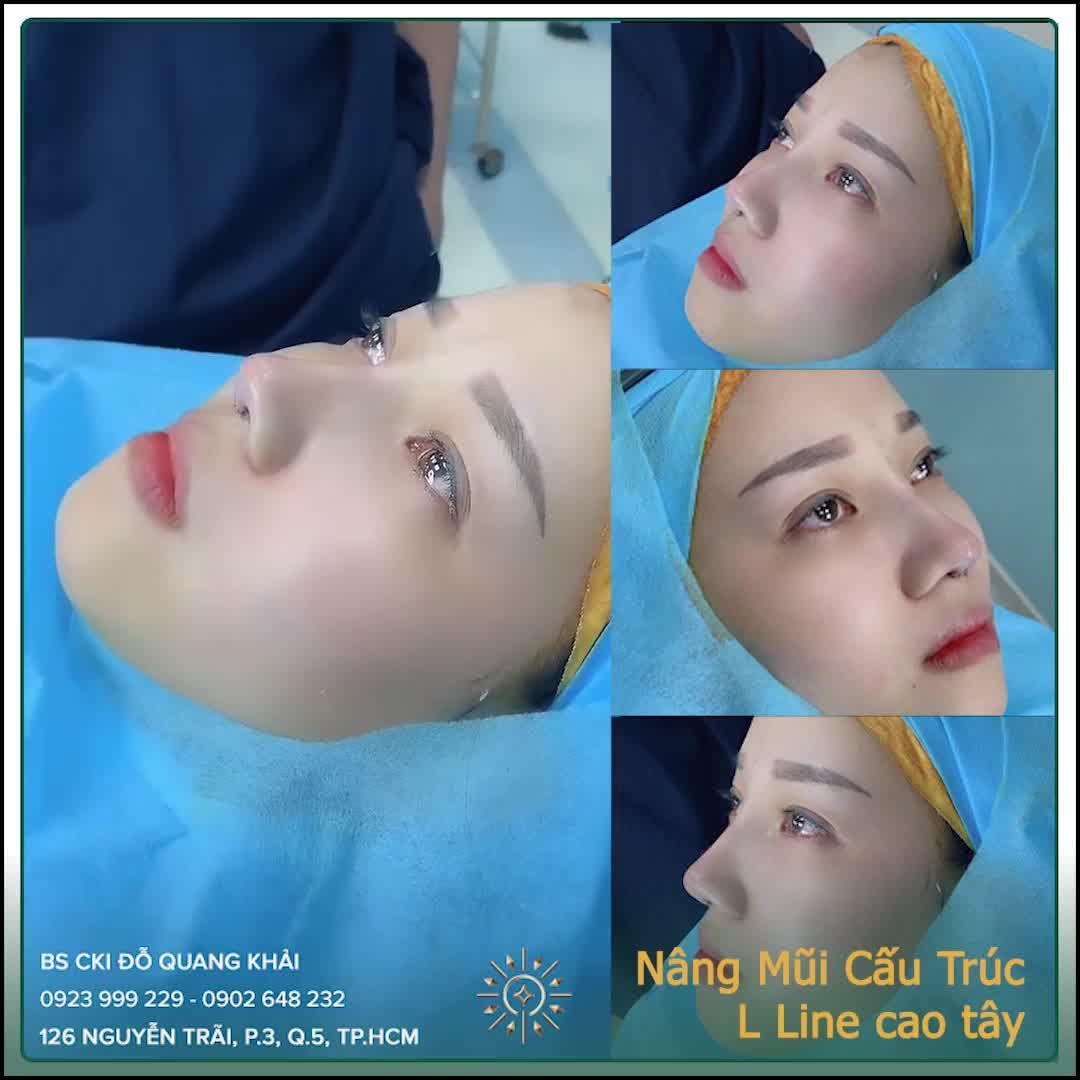 MŨI CẤU TRÚC LÊN FORM NGAY SAU KHI PHẪU THUẬT