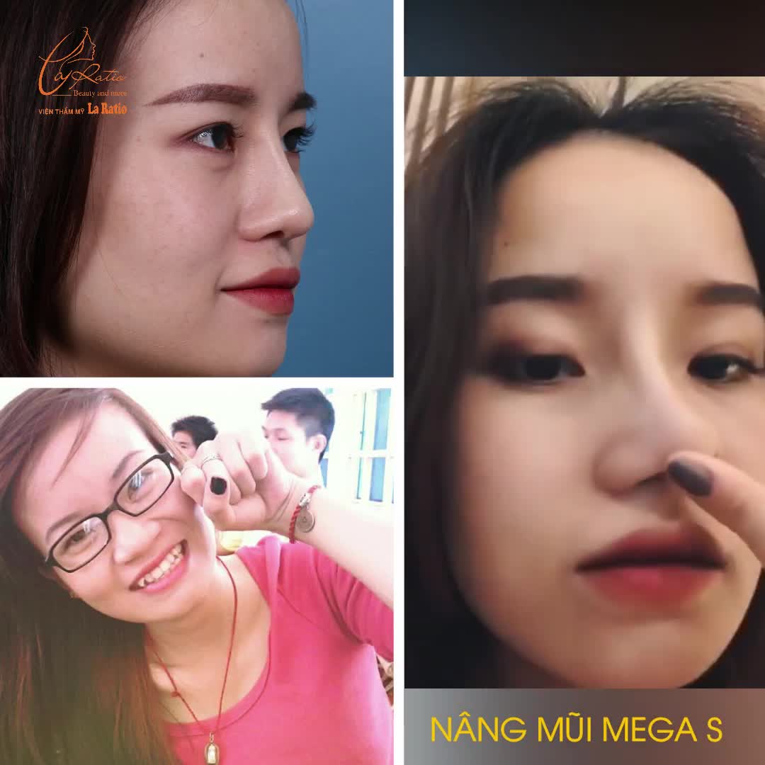 NÂNG MŨI MEGA S - TỰ TIN THAY ĐỔI ĐƯA NHAN SẮC LÊN TẦM MỚI