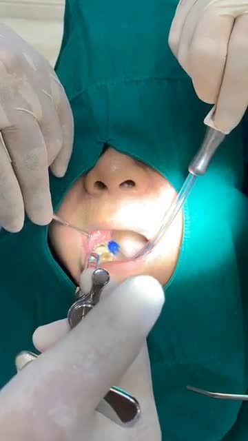 NHỔ RĂNG KHÔN MỌC LỆCH SIÊU KHÓ BẰNG MÁY SIÊU ÂM.