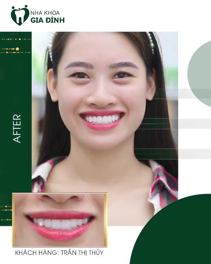 THÁNG 6 NÀY THẨM MỸ RĂNG ƯU ĐÃI ĐẾN 60%