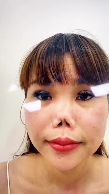 TÁI CẤU TRÚC CHO CA MŨI HƯ NẶNG: sửa mũi 5 lần, biến dạng hoàn toàn đầu mũi, co rút nặng