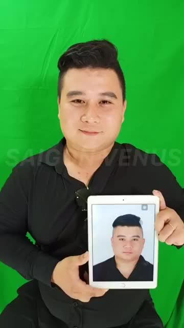Tái khám mũi Cấu trúc Surgiform sau gần 1 năm cho dáng mũi Nam
