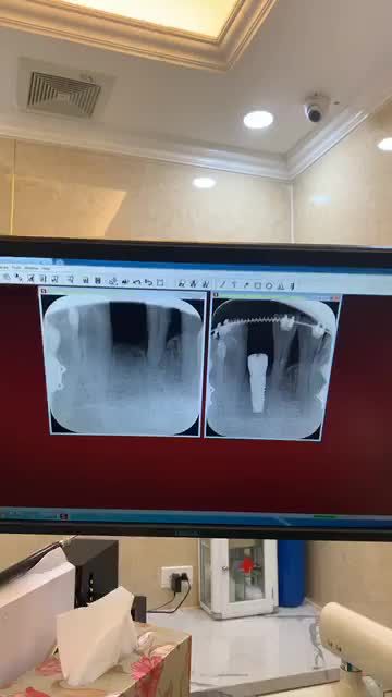 TRỒNG RĂNG IMPLANT THAY THẾ RĂNG MẤT
