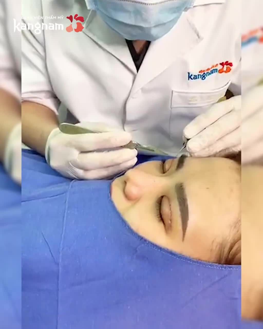 Bạn băn khoăn: Cắt mí bao lâu HẾT SƯNG? Bao lâu thì ĐẸP?