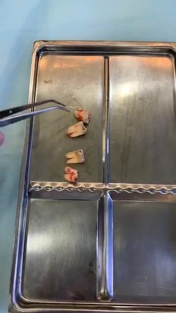 Nhổ 4 răng khôn trong 15 ph. Khách hàng nhổ răng thứ 24 trong ngày