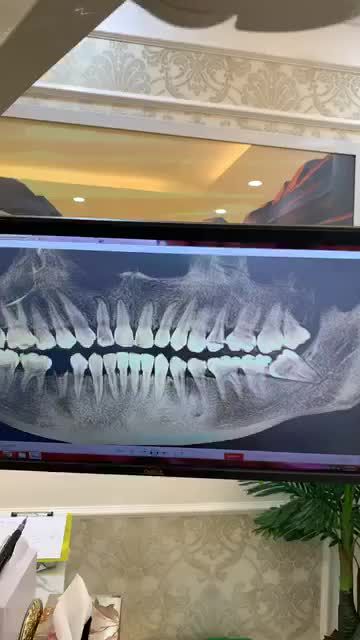 Nhổ Răng khôn siêu khó lệch 90 độ Bằng máy siêu âm.