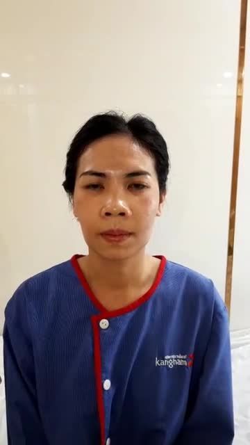 Khách hàng trò chuyện bình thường chỉ sau 2 ngày chỉnh hàm hô móm, không sưng - không đau - không phù nề