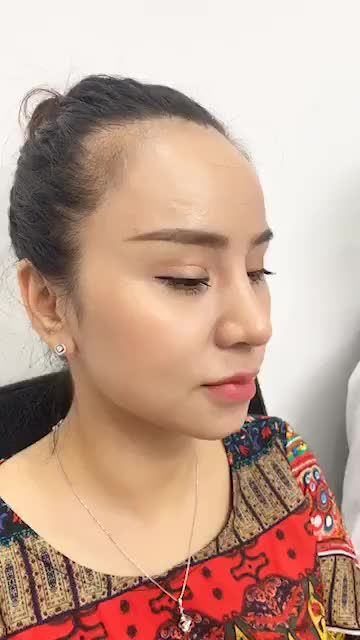 Nâng mũi gì lại ĐẸP THẦN THÁI - Hút mắt đến vậy?