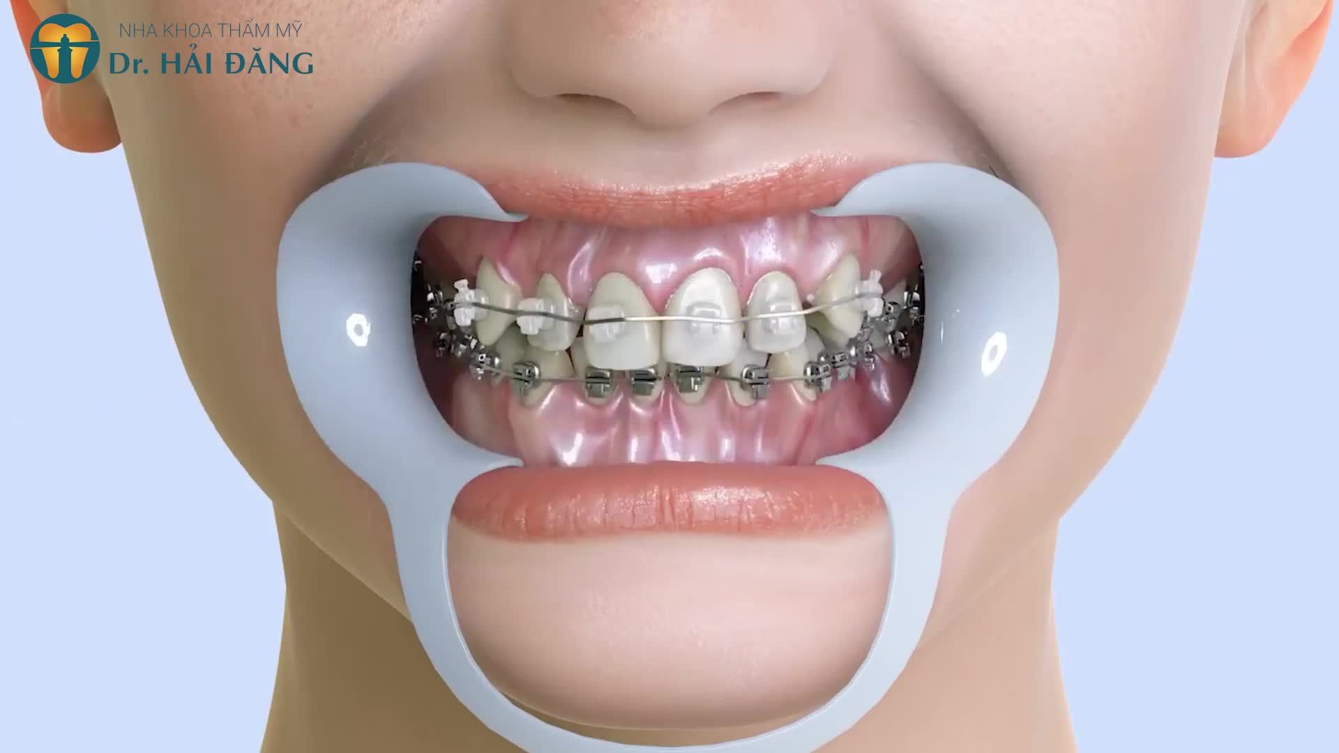 BẠN THẮC MẮC QUÁ TRÌNH NIỀNG RĂNG THẾ NÀO?