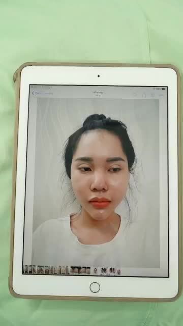 CA SỬA MŨI HỎNG CHO KHÁCH HÀNG BẰNG PP NÂNG MŨI SỤN SƯỜN VỪA MỚI ĐƯỢC THỰC HIỆN XONG