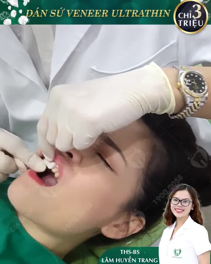 DÁN SỨ VENEER: TÂN TRANG NỤ CƯỜI – RẠNG NGỜI NHAN SẮC