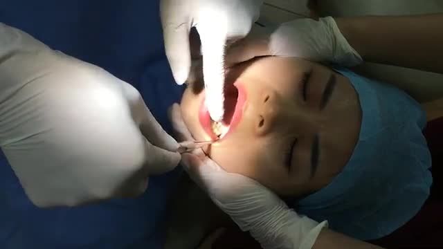 Nhổ răng khôn lệch 45 độ và chân răng 7 sâu vỡ nghiêm trọng cho chị Ninh.