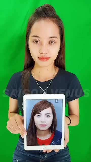 Tái khám 2 tháng nâng mũi Sụn sườn Fascia Surgiform cuộn cánh.
